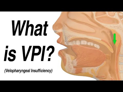 Velopharyngeal Insufficiency (VPI) Causing Hypernasal Speech and Nasal Regurgitation with Swallow