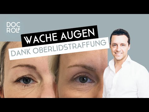 OBERLIDSTRAFFUNG OP / Blepharoplastik Q&A – mit Dr. Rolf Bartsch
