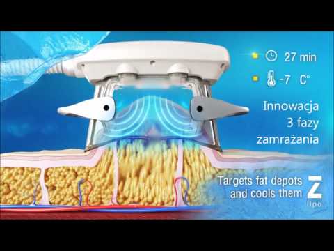 ZLipo - Animacja Systemu Zabiegowego Kriolipolizy