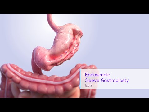 Endoscopic Sleeve Gastroplasty Animation- Apollo ESG System