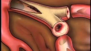 Natural Treatment for Heart Disease