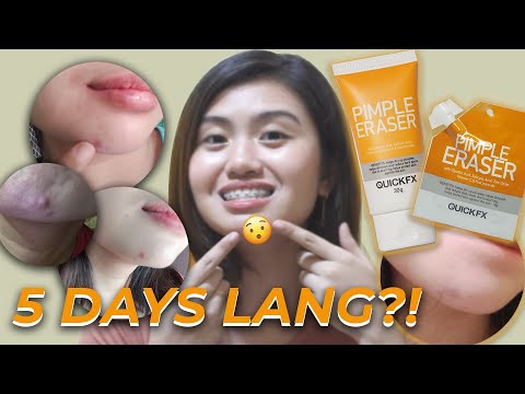 SOLUSYON SA PIMPLES?! QUICK FX PIMPLE ERASER REVIEW