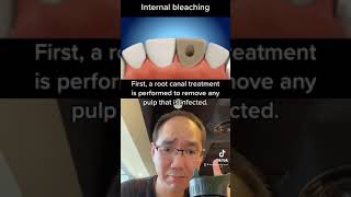 How internal whitening on a dead tooth? 🧐