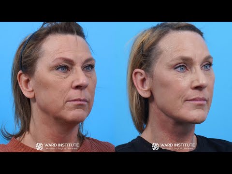 Facelift by Dr. Ward. Amazing. Best Results. SO happy I did it. It has changed my life for the better in so many ways.