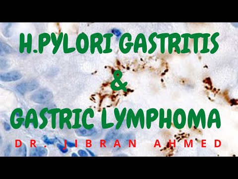 GASTRIC CARCINOMA II GIT II ROBBINS 10TH E II PATHOLOGY LECTURES II DrJIBRANAHMED