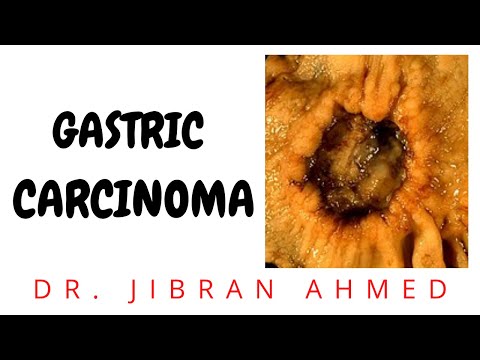 GASTRIC CARCINOMA II GIT II ROBBINS 10TH E II PATHOLOGY LECTURES II DrJIBRANAHMED