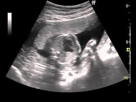 Hypoplastic Left Heart Ultrasound Video and Fetal Echo