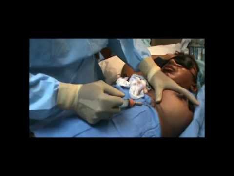 Fat Transfer To Breast