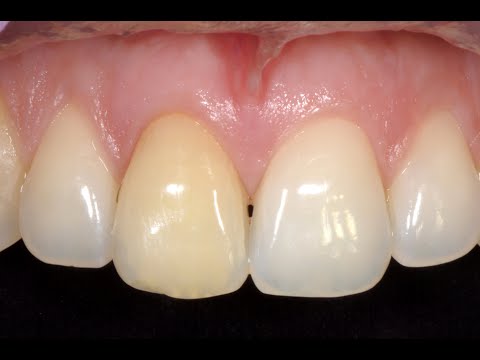 Retreatment and endodontic bleaching of a maxillary central incisor