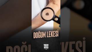 Doğum Lekesi