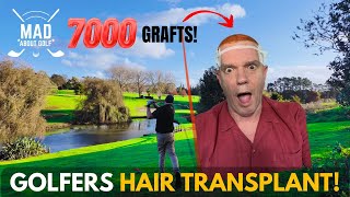 A Golfers Hair Transplant! 7000 grafts!
