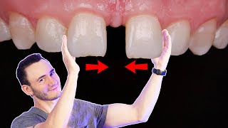 Espacio entre los dientes | Tratamientos para cerrar un Diastema