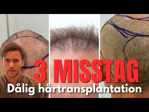 MISSLYCKAD hårtransplantation (3 fel) - Så korrigerar vi misstagen