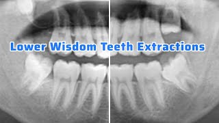 Purchase Point to Remove These Lower Wisdom Teeth
