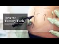 Reverse Tummy Tuck