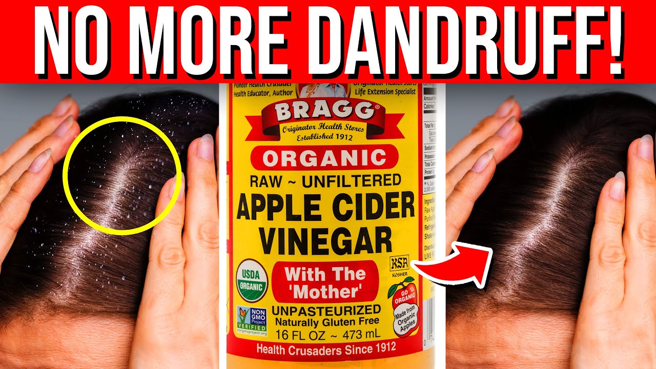 8 NATURAL Ways You Can GET RID OF Dandruff Fast