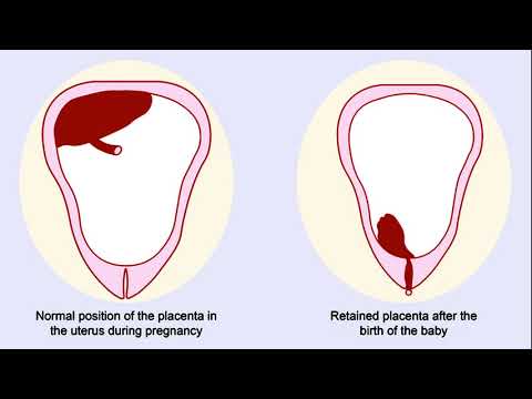 What Is a Retained Placenta?
