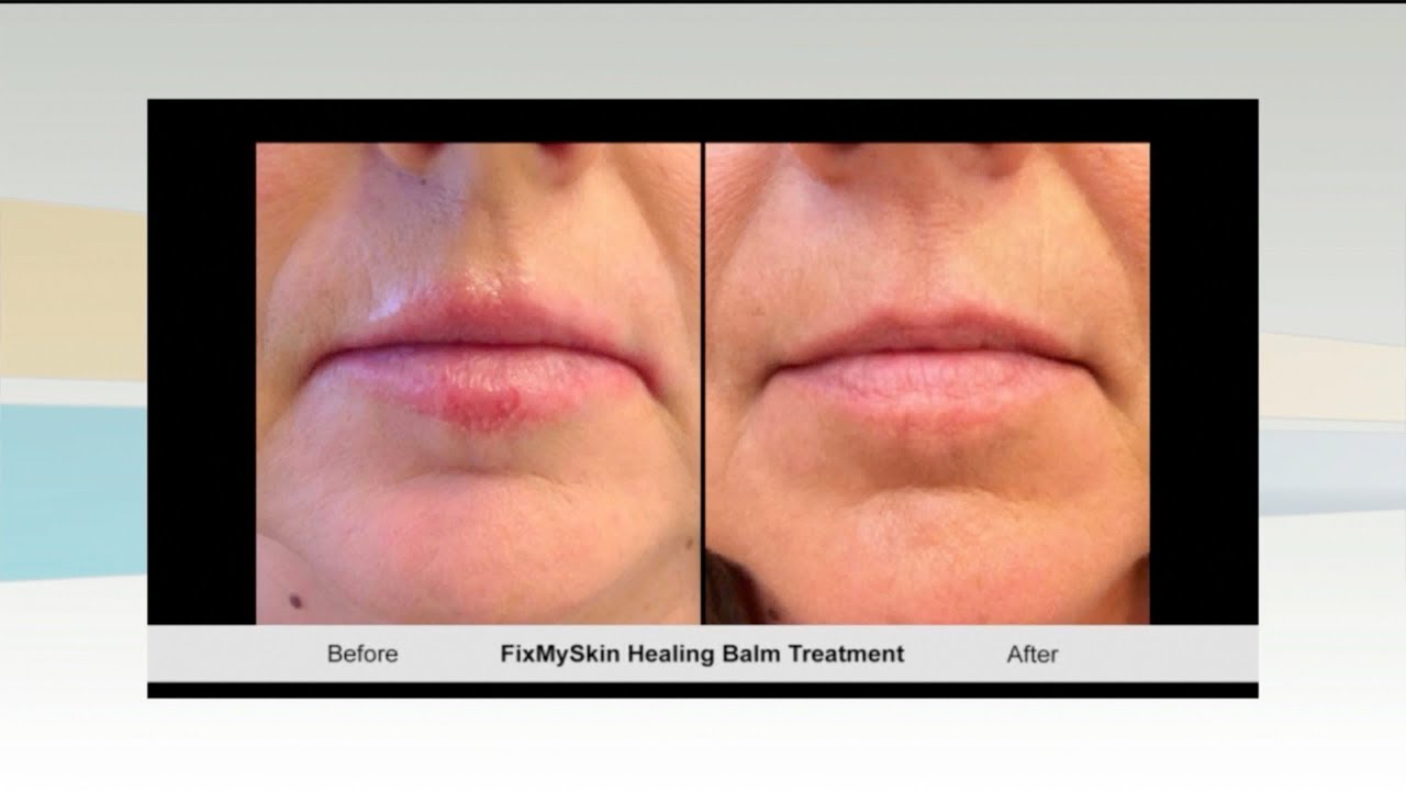 FixMySkin 1 Hydrocortisone Healing Lip Balm Unflavored LovelySkin