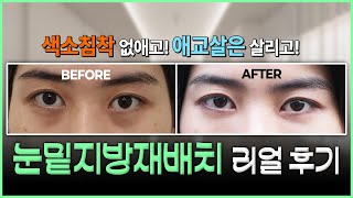 리얼 후기🔥 [눈밑지방재배치] 하나로 눈밑꺼짐, 다크써클은 없애고 애교살도 살릴 수 있습니다! #큐디의원 #어븀눈밑지방재배치 #색소침착