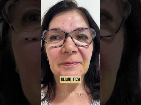 12 implanturi și zâmbetul pe care îl aștepta de ani
