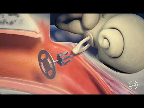Kurz Passive Middle Ear Implants - Tympanoplasty Clip® Partial Prosthesis Dresden Type