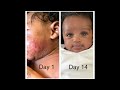 Clear Infant seborrheic dermatitis in 14days! | #BuildingwithGoose
