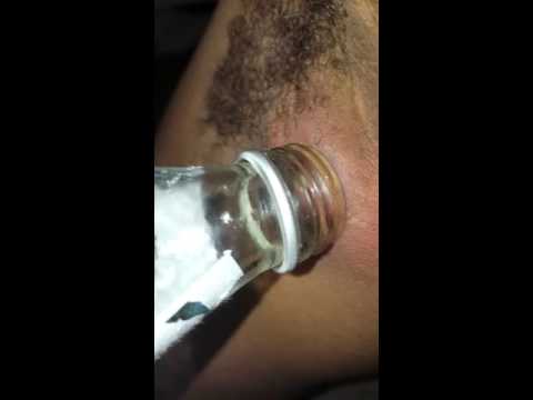 Boil (Cyst) Bottle trick part 1