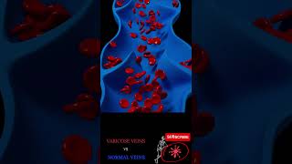 SPIDER veins (Varicose) vs normal veins blood flow