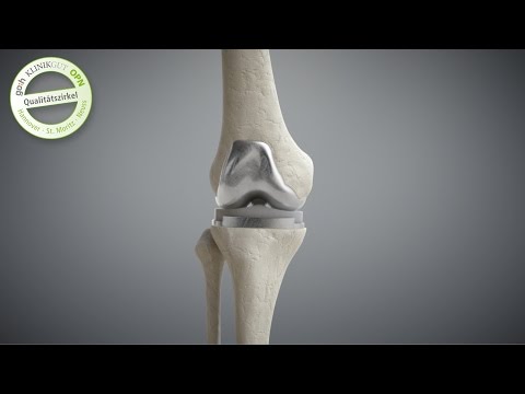 Arthritis, Arthrose Gelenk des Daumens Wunder unterer Rücken zieht das Bein