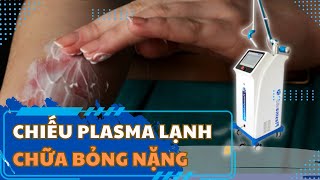PlasmaMED: Chiếu tia plasma lạnh điều chị vết vỏng nặng.