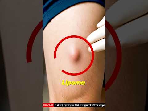 Ayurvedic Remedy for Lipoma | How to Cure Lipoma Naturally | Natural Way to Shrink Lipoma