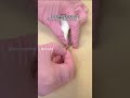 Extraction Of An Omphalolith In A Patient S Belly Button