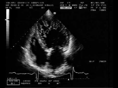 Left Ventricular Noncompaction