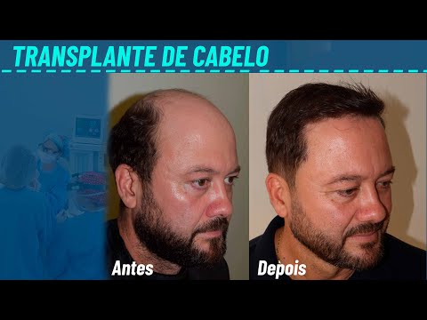 Miniatura do depoimento: Minha Experiência com Transplante Capilar na Mansur