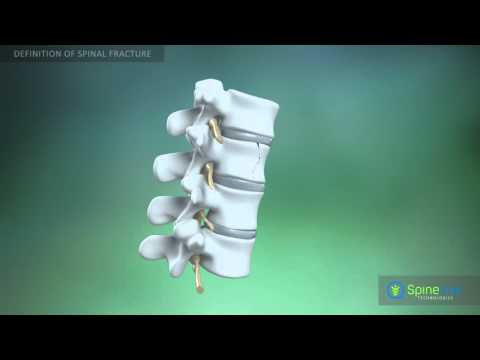 Spinal fractures. Definition