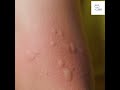 Causes of Hives
