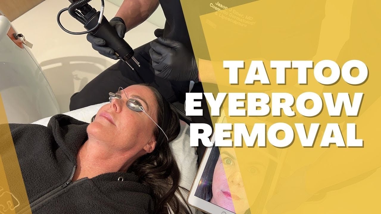 ASTANZA RUBY LASER FOR TATTOO EYEBROW REMOVAL | Dr. Jason Emer