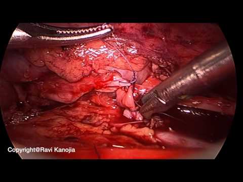 Retroperitoneoscopic Pyeloplasty