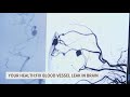 AVM: Gargantuan headaches and leaking blood vessels in the brain