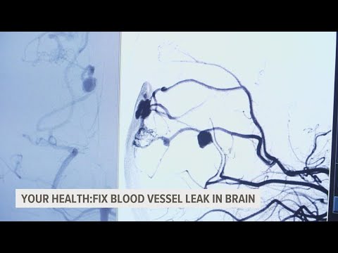 AVM: Gargantuan headaches and leaking blood vessels in the brain
