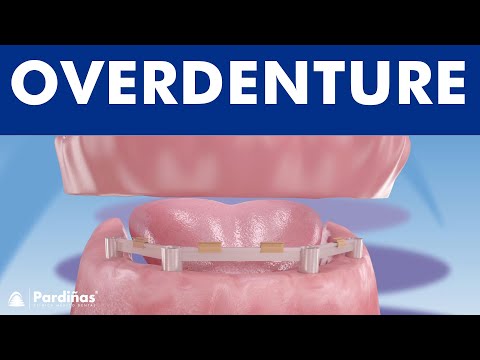 Overdenture with dental implants ©