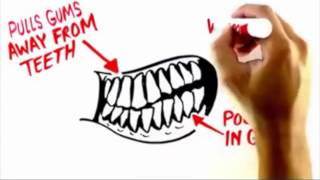 preview picture of video 'Periodontal Disease   Gum Disease - Belleville WI Dentist'