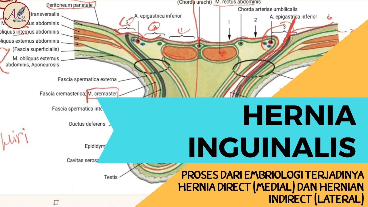 Hernia Inguinal : Hernia Direct (Medial) dan Hernia Indirect (Lateral)