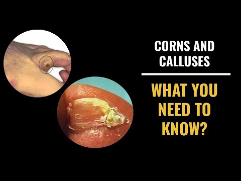 Corns and Calluses - What you need to know!