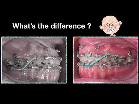 Use of Elastics and Space Generation in Midline Correction｜【Chris Chang Ortho】CC489