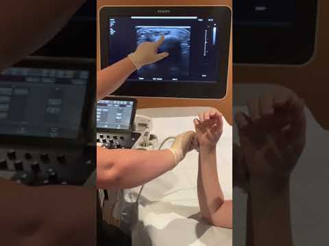 Dynamic wrist ultrasound of extensor carpi ulnaris (ECU) tendon to r/o subluxation or dislocation