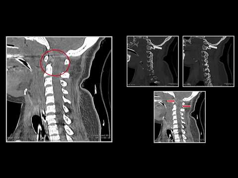Spinal Trauma | Interesting Radiology Cases