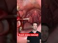 Tonsil Stone Be Gone Shorts