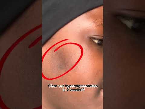 Solve hyperpigmentation spots with Mary&May Tranexamic Acid+Glutathione Eye Cream in 2 WEEKS!