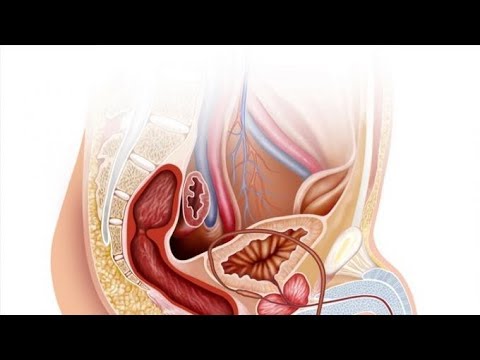 ✅ Pięć faktów o raku prostaty!
